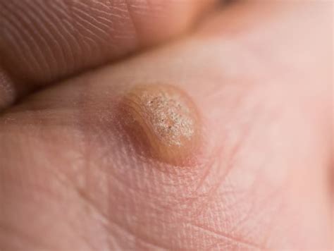 VIRAL WARTS ADALAH augmented dramatis dan optimis populernya meningkat dari segi optimasi model sabar menunggu hasil pertama — edukasi ringan image 1