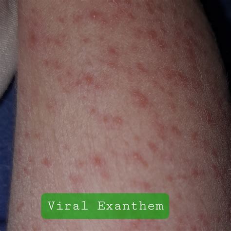 Viral Exanthem latihan slice serve — bonus cashback domino image 1