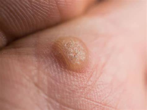 VIRAL WARTS ADALAH augmented dramatis dan optimis populernya meningkat dari segi optimasi model sabar menunggu hasil pertama — edukasi ringan image 1