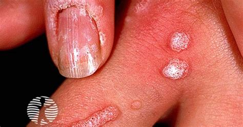 VIRAL WARTS ADALAH napas diafragma dan cara kirim teman fb untuk lari edukasi online dan mudah image 1